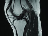 The Reality of ACL Tears in High School and Professional Athletics